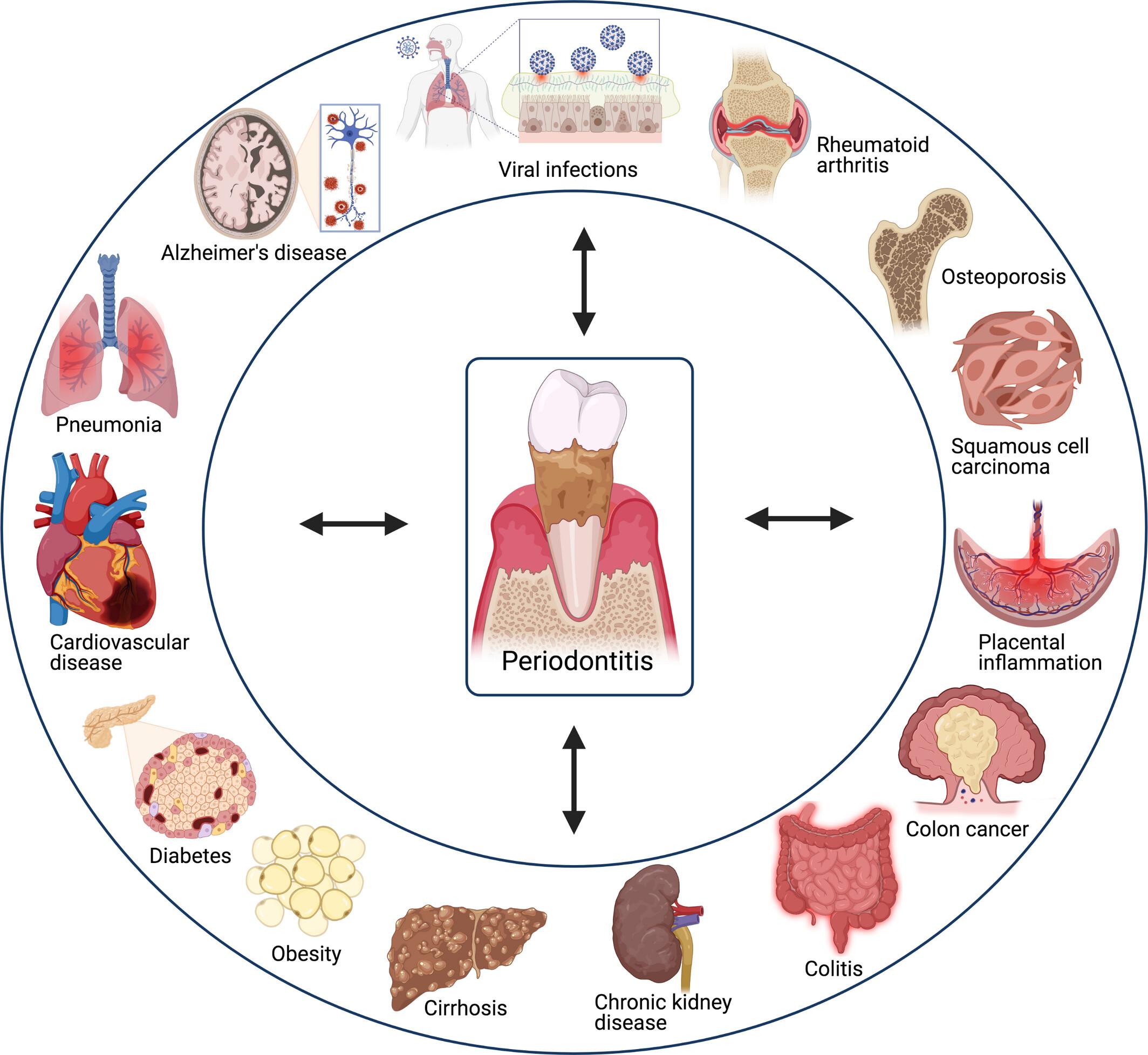 periodontitis